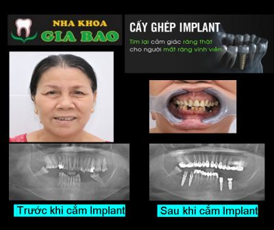 Khách hàng NGUYỄN THỊ VUI - Cắm Ghép Implant