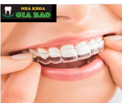 CHỈNH NHA - NIỀNG RĂNG TRONG SUỐT