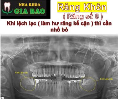 NHỔ RĂNG KHÔN