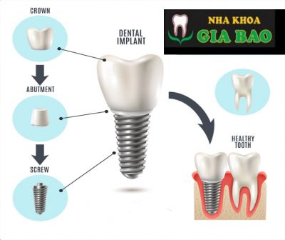 Cấy ghép Implant