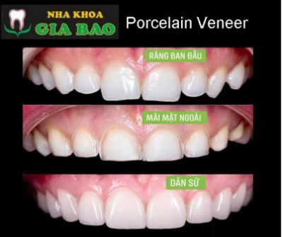 MẶT DÁN SỨ VERNEER